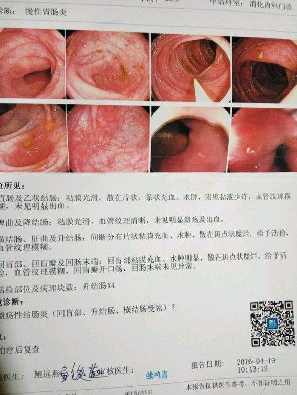 关于溃结最新治疗的探讨